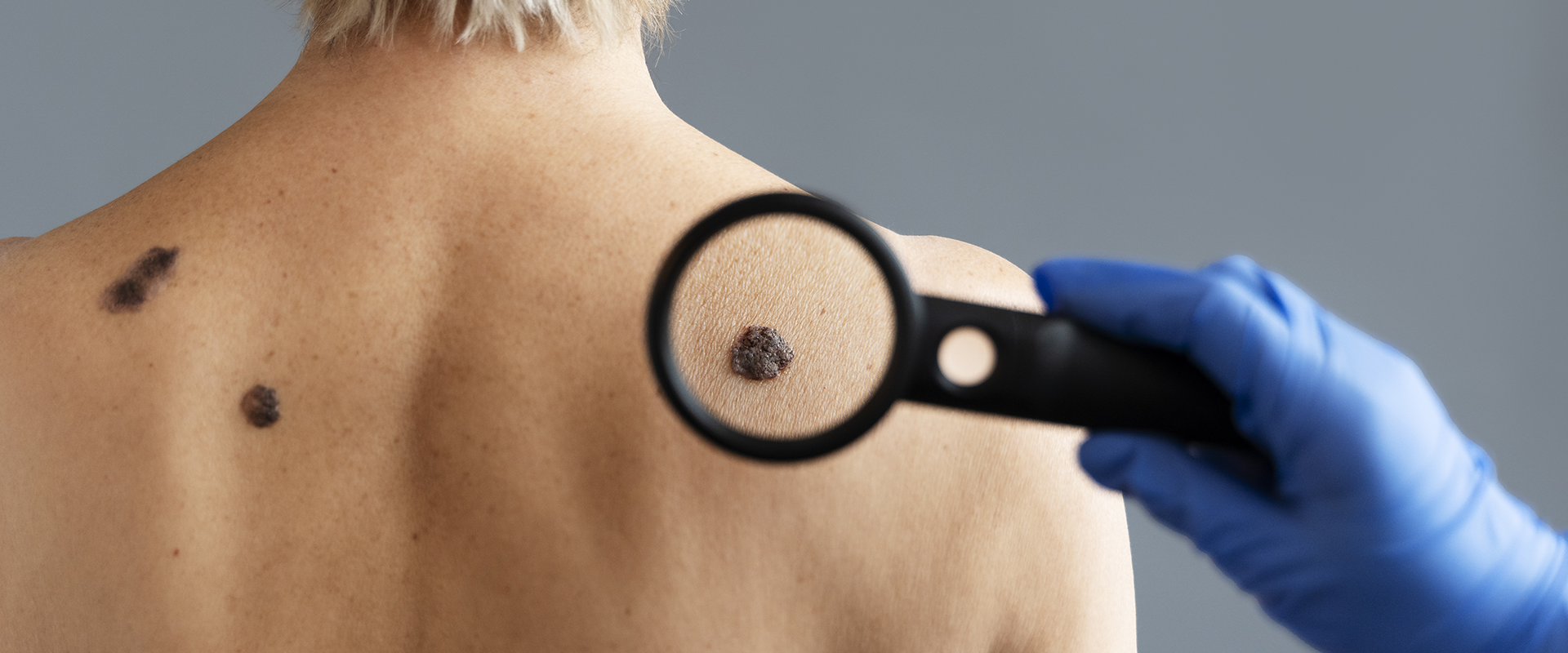 Mole Removal 